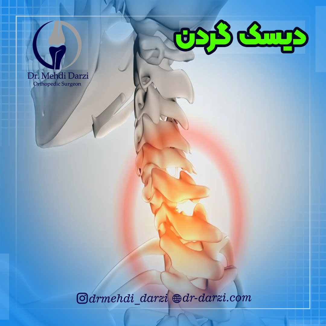 بیماری دیسک گردن یا(hernation disc cervical) چیست؟