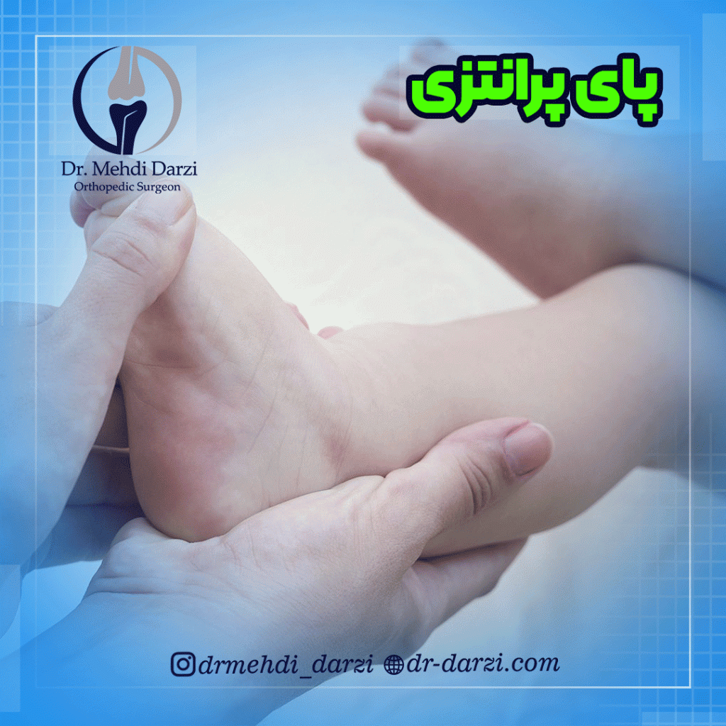 پای پرانتزی در کودکان و بزرگسالان
