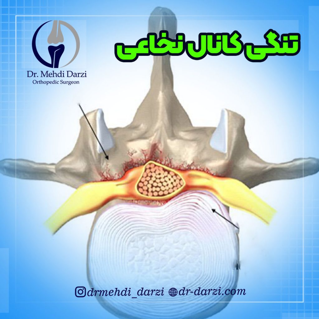تنگی کانال نخاعی