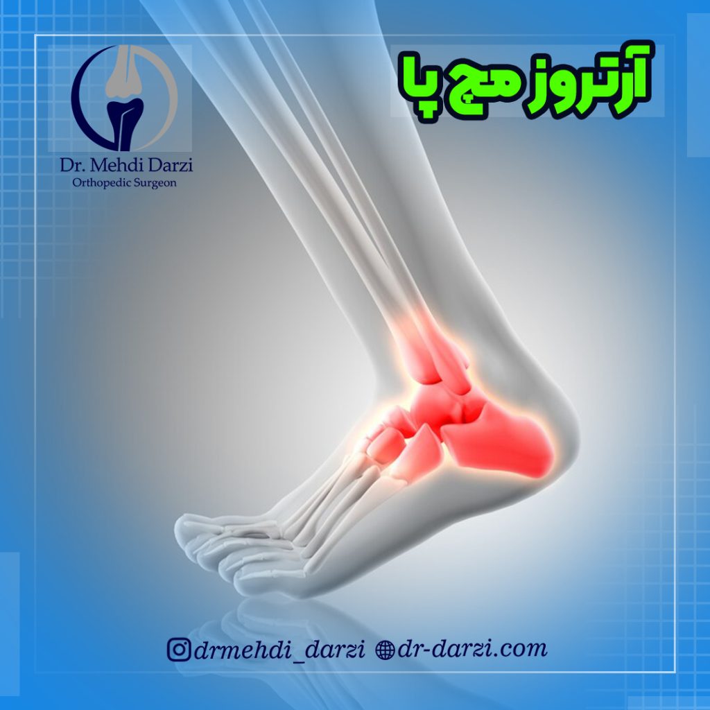 آرتروز مچ پا