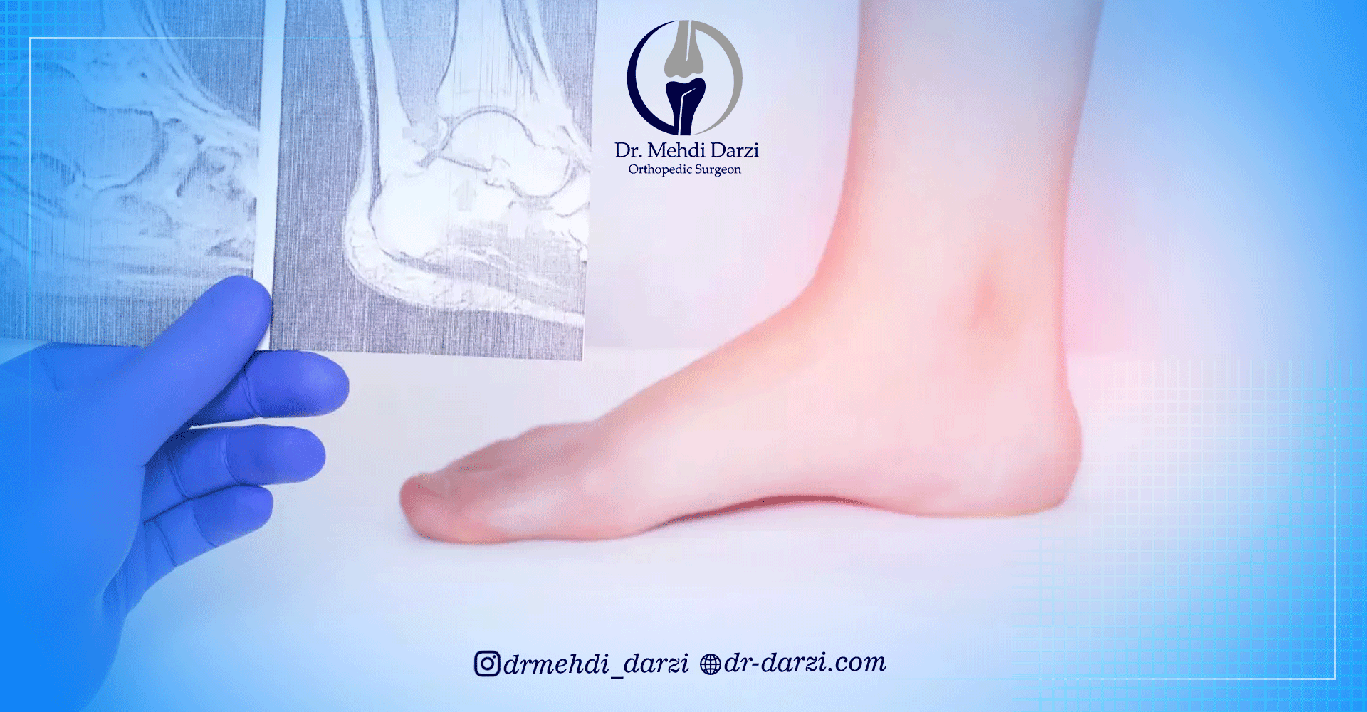 درمان آرتروز مچ پا با استفاده از فیزیوتراپی: