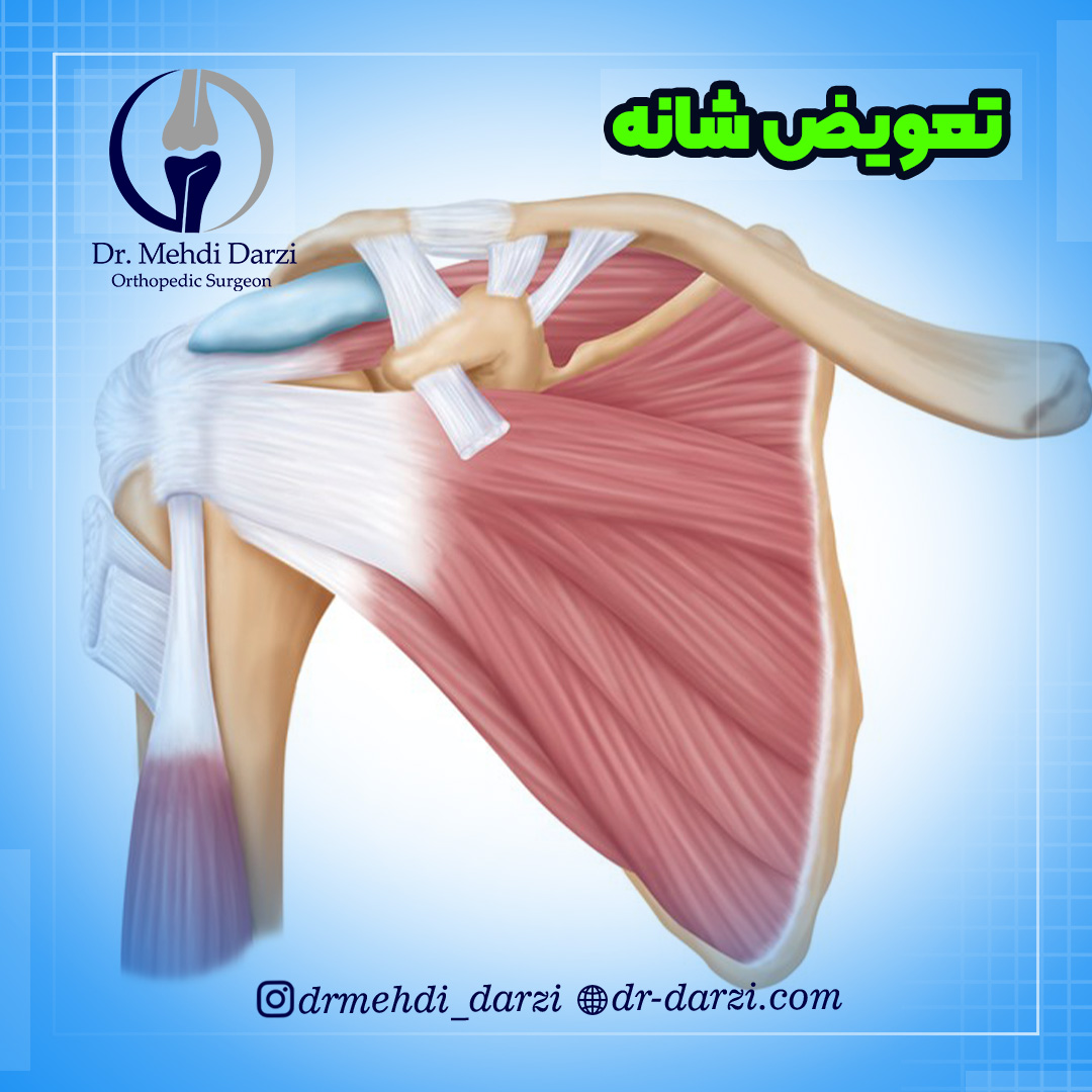 تعویض مفصل شانه