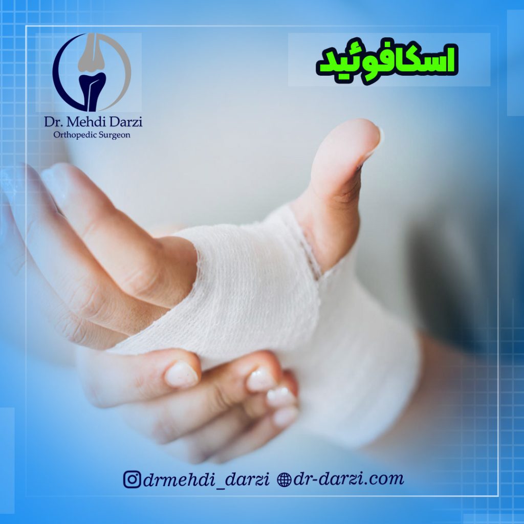 شکستگی استخوان اسکافوئید