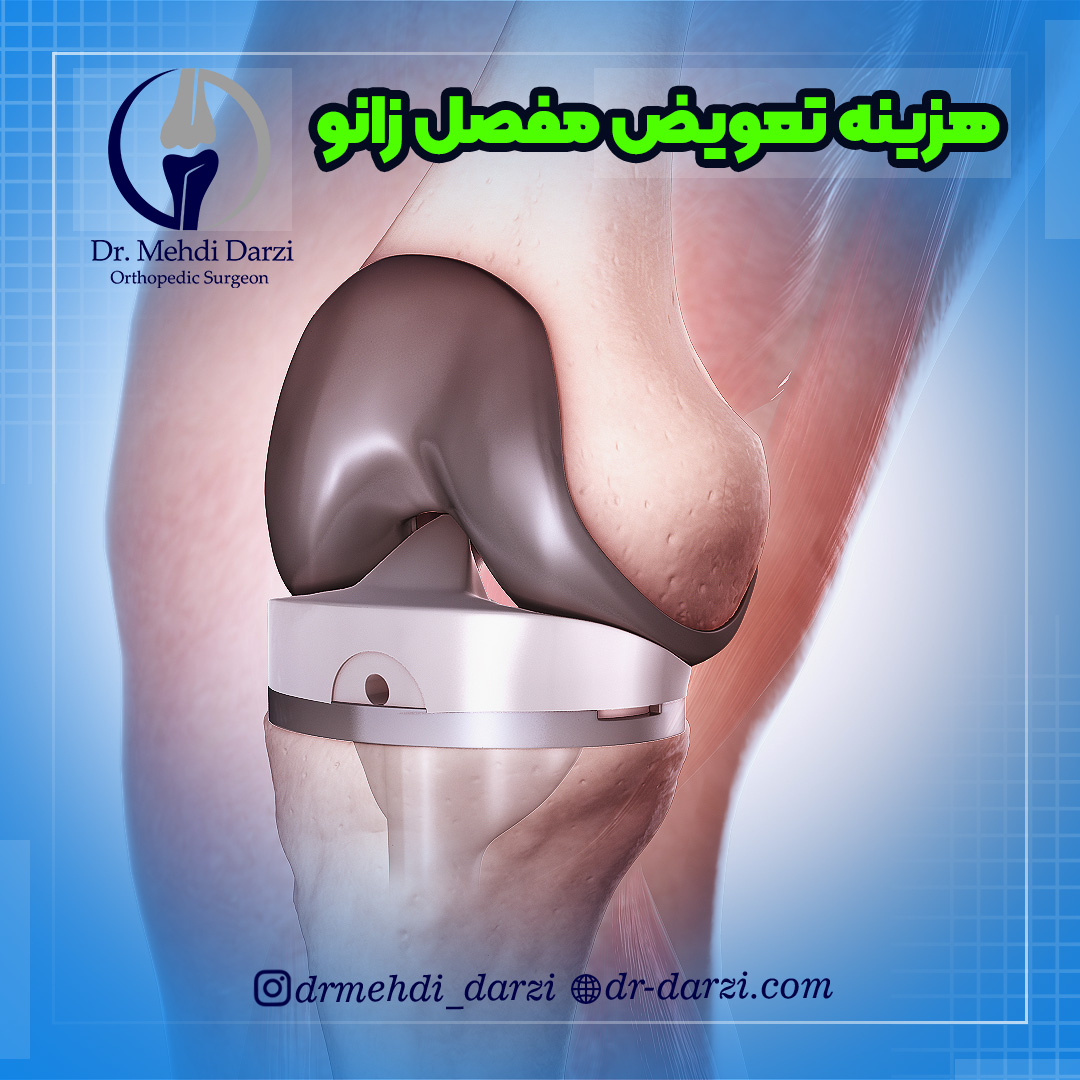 هزینه تعویض مفصل زانو در سال 1403