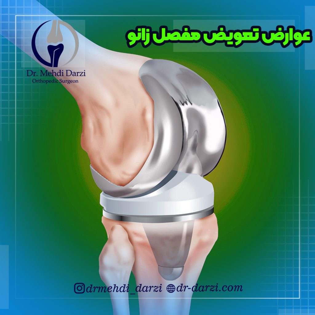 عوارض تعویض مفصل زانو