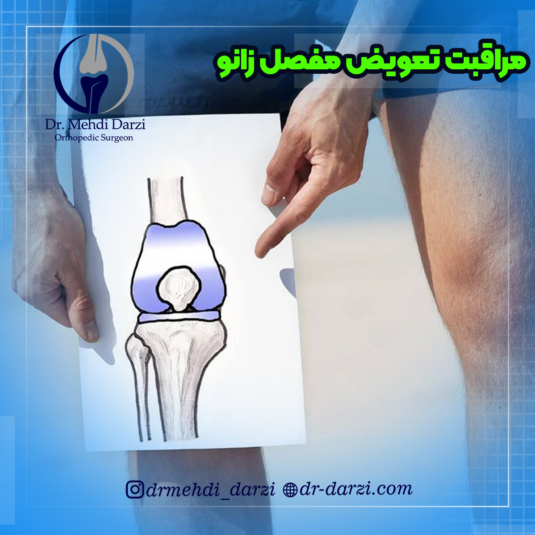 مراقبت تعویض مفصل زانو