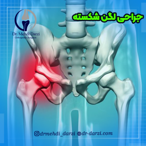 جراحی لگن شکسته