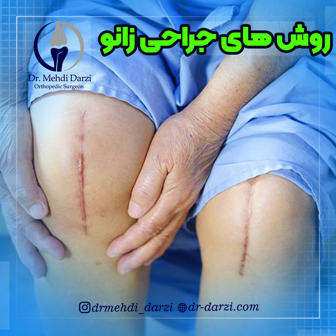 انواع روش های جراحی زانو