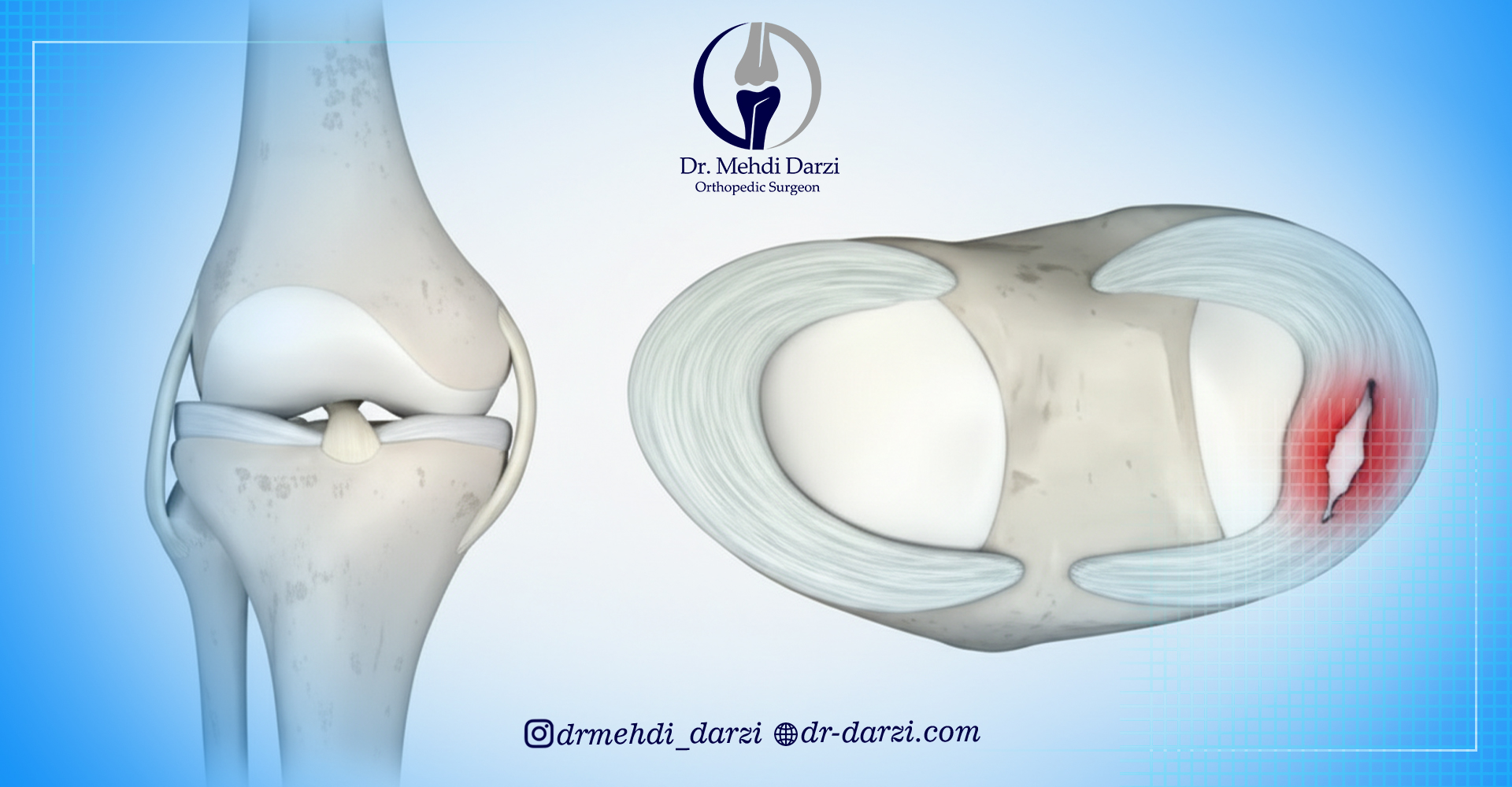 علائم پارگی مینیسک زانو