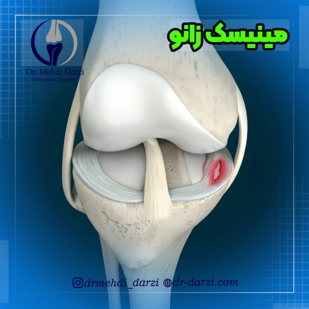 مینیسک زانو