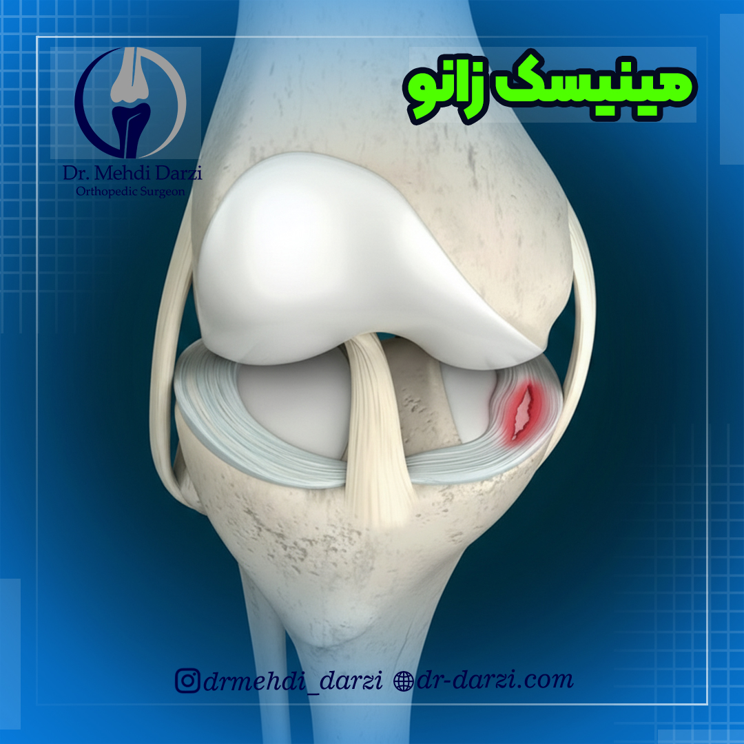مینیسک زانو