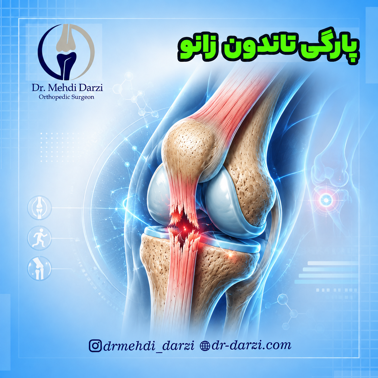 پارگی تاندون زانو