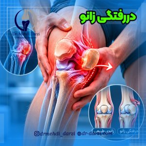 دررفتگی زانو چیست؟