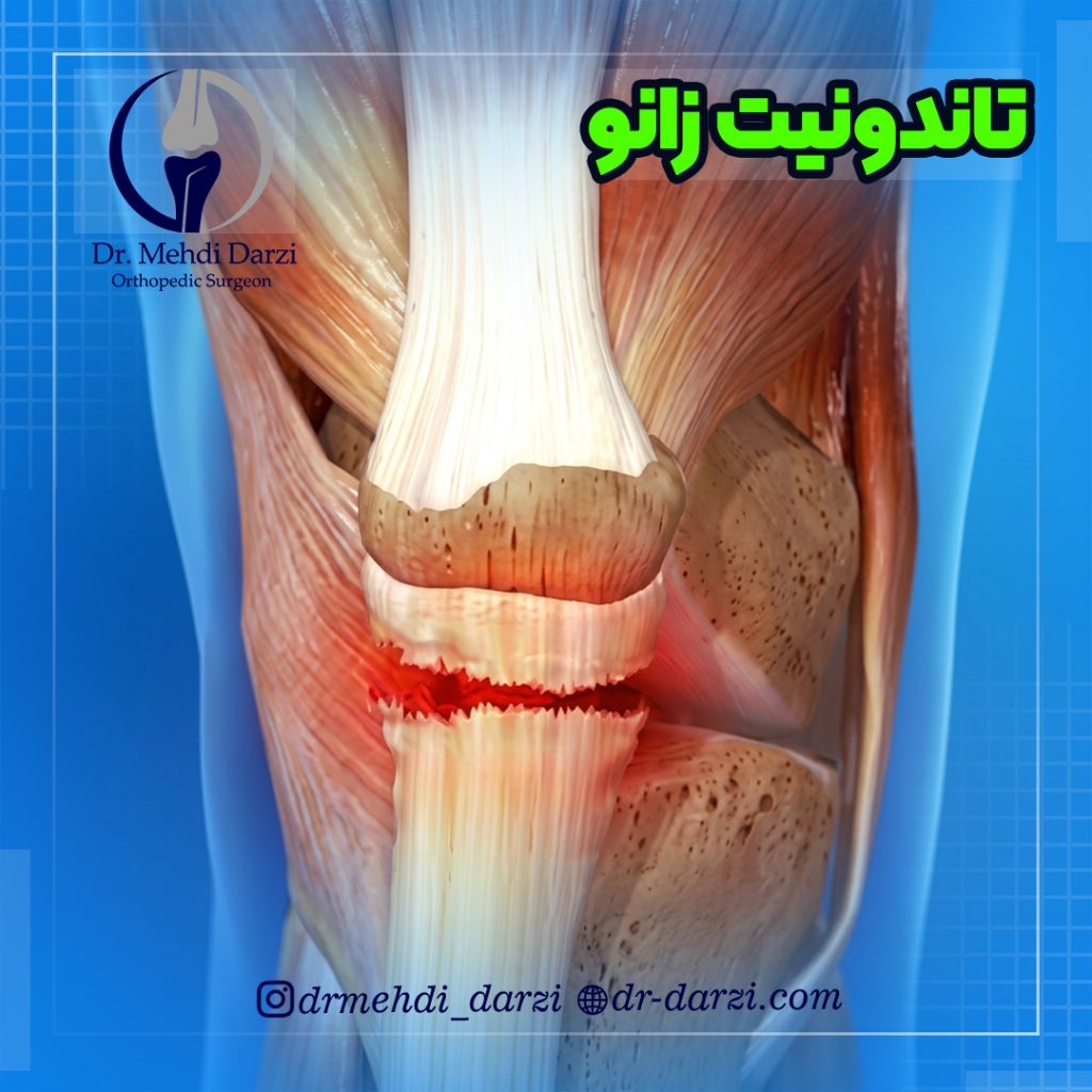 تاندونیت زانو چیست؟