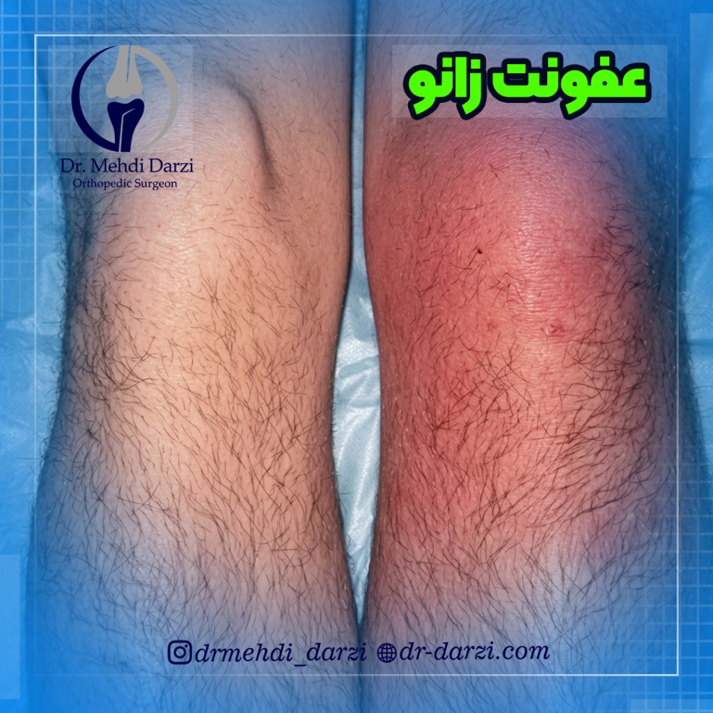 عفونت زانو چیست؟