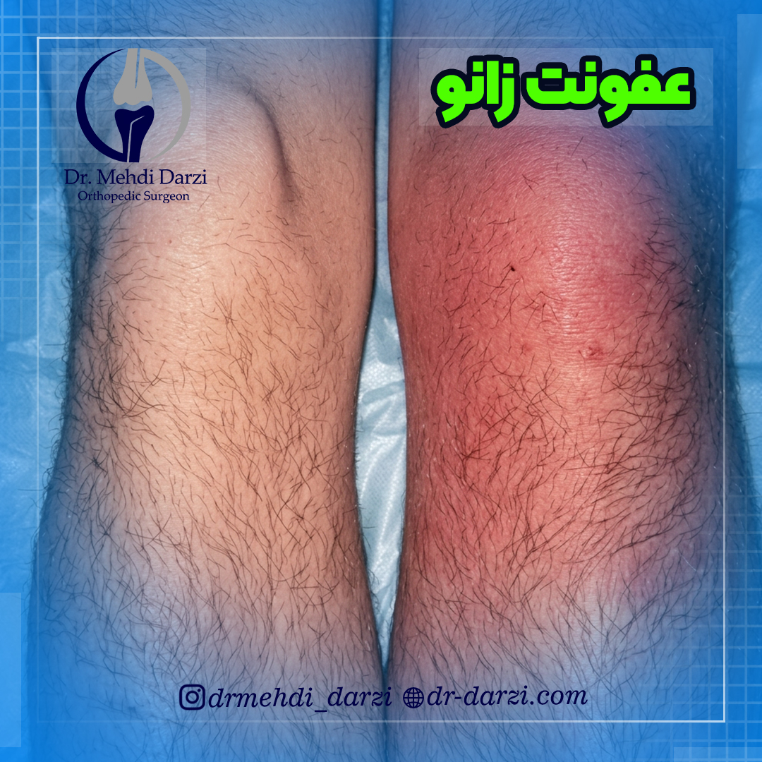 عفونت زانو چیست؟
