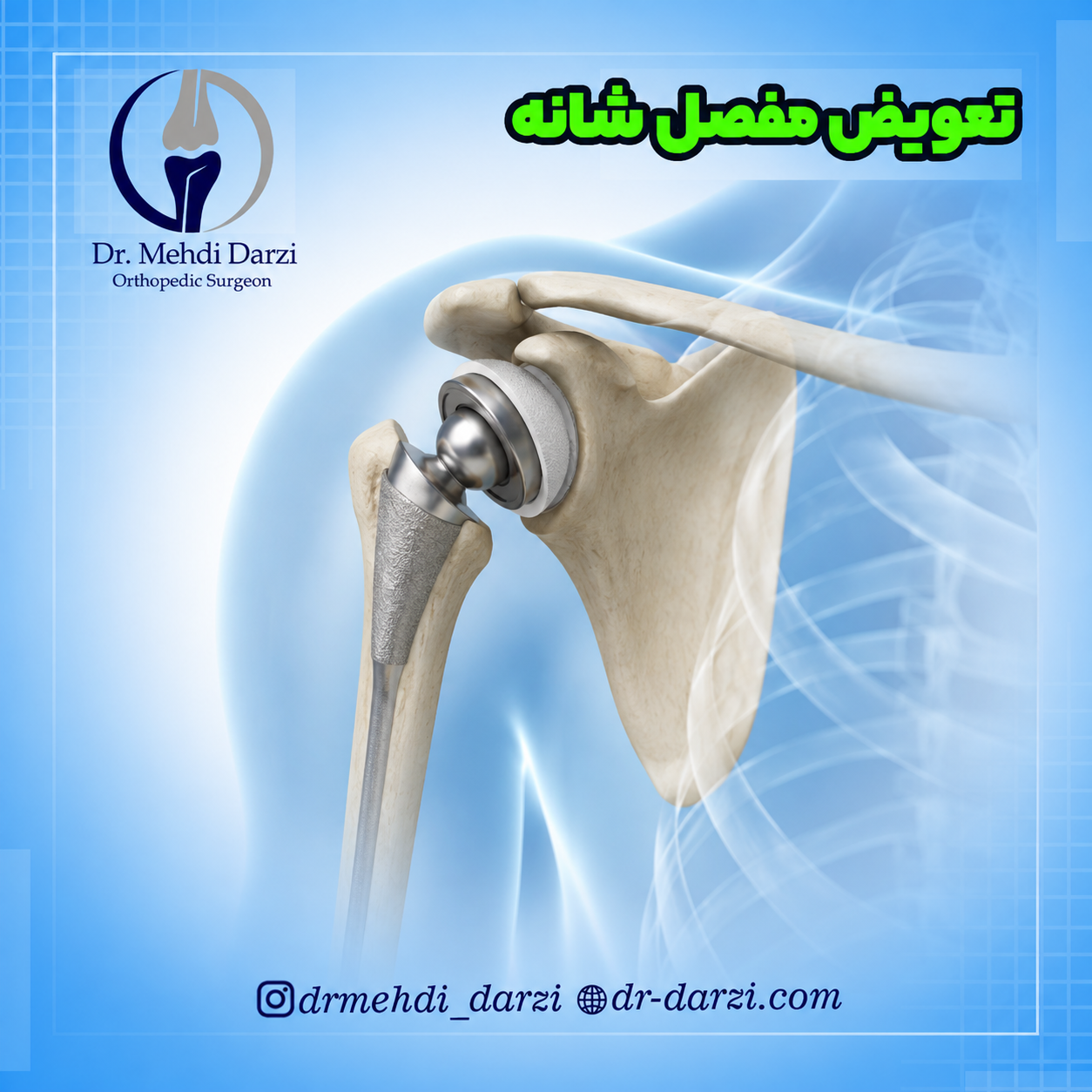 تعویض مفصل شانه